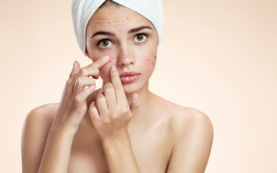 Is It True Spicy Food Causes Acne?