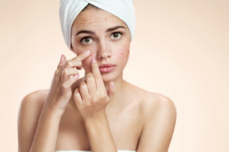 Is It True Spicy Food Causes Acne?
